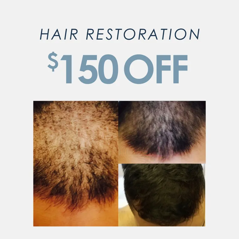 PRP Hair Restoration | $150 OFF
