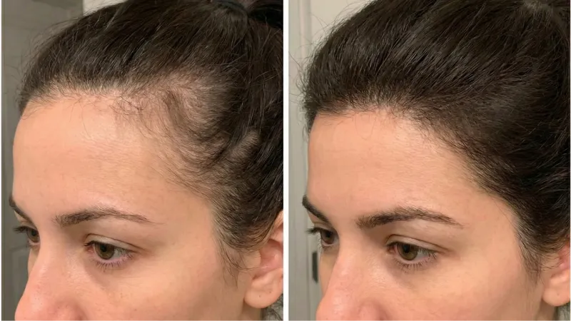 Heather L. — result after 80 days