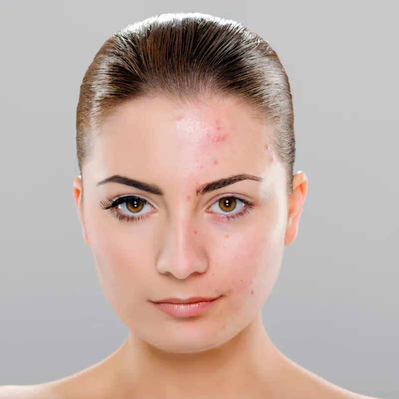 Acne Facial