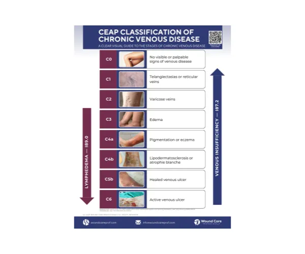 Guide: CEAP Classification of Chronic Venous Disease