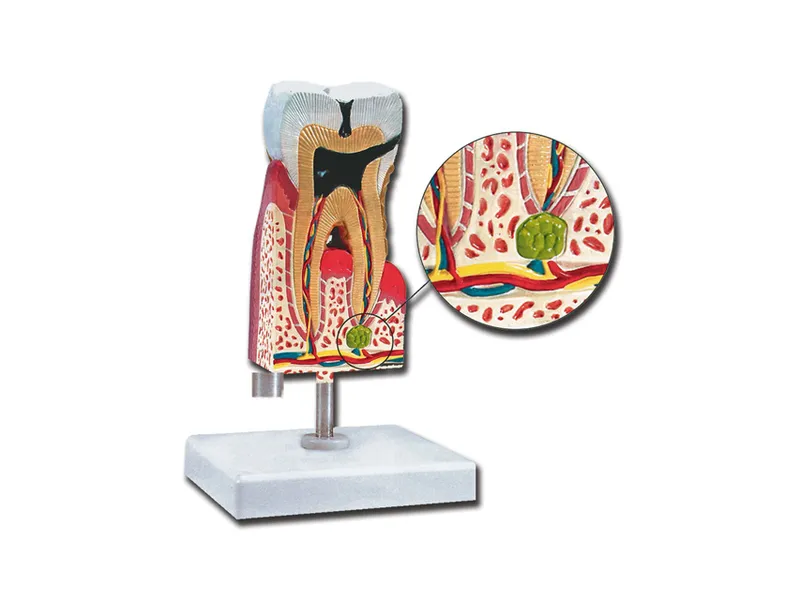 [A00014139] - Molare inferiore con carie