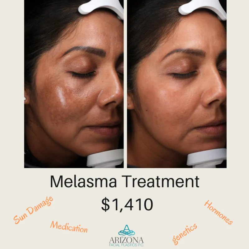 melasma correction