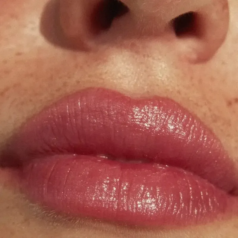 Botox Lip Flip