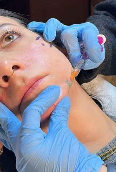 Filler contouring mandibolare  