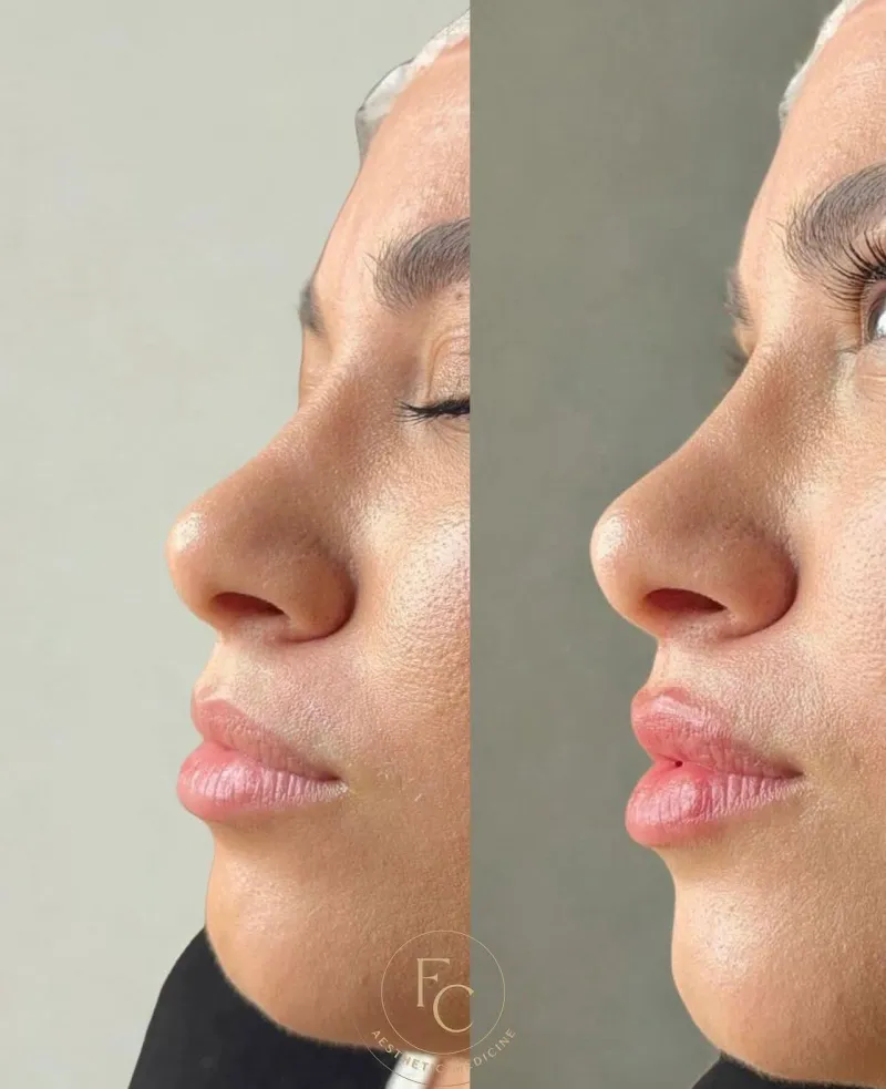 Filler Labbra Hydra – Idratazione e Contorno Naturale