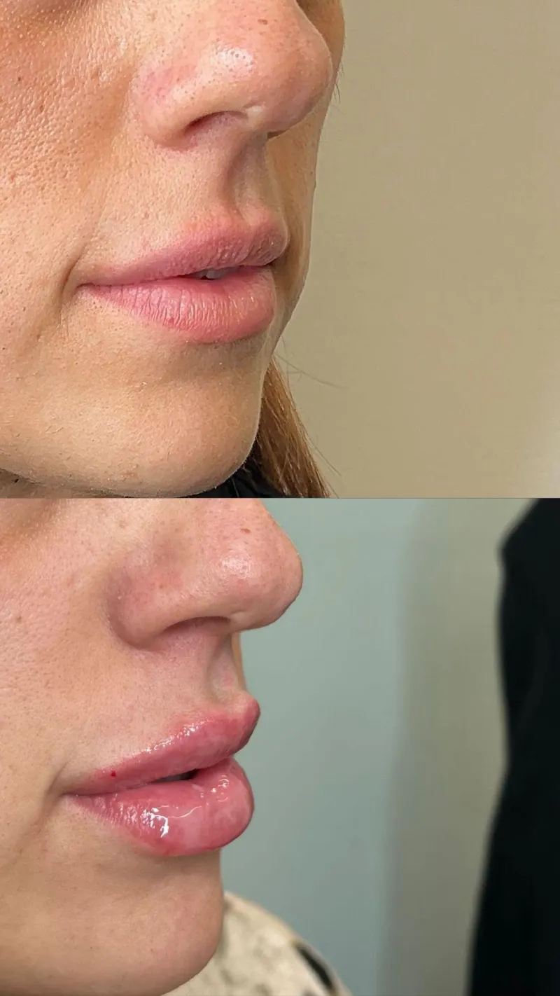 Filler Labbra Bit Volume – Definizione e Volume su Misura
