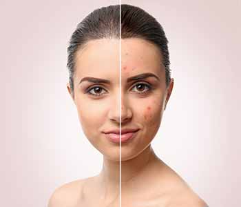 Acne Consultation 