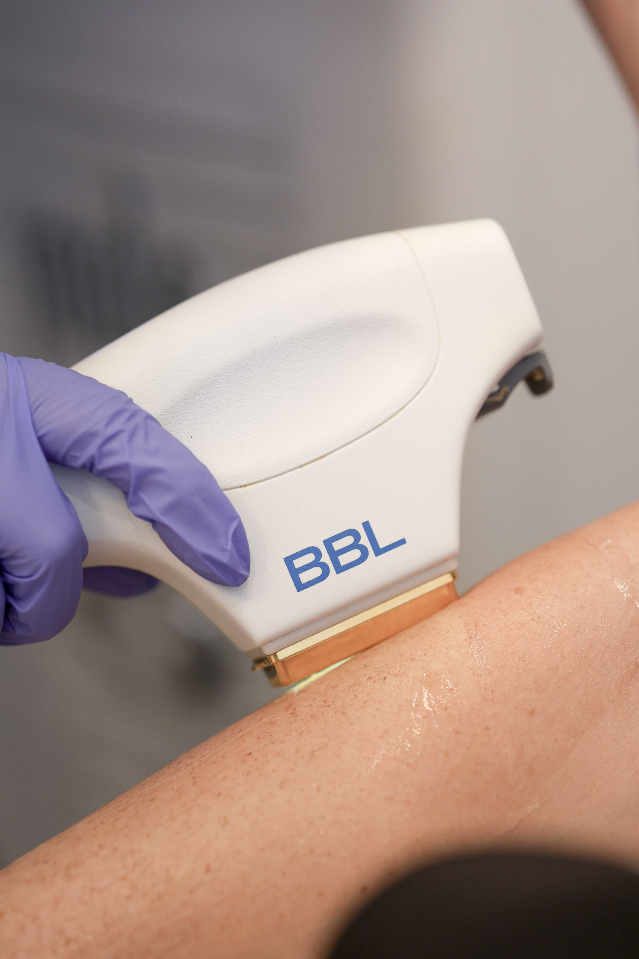 LZR- BBL by Sciton for Age/Sun Spots Removal