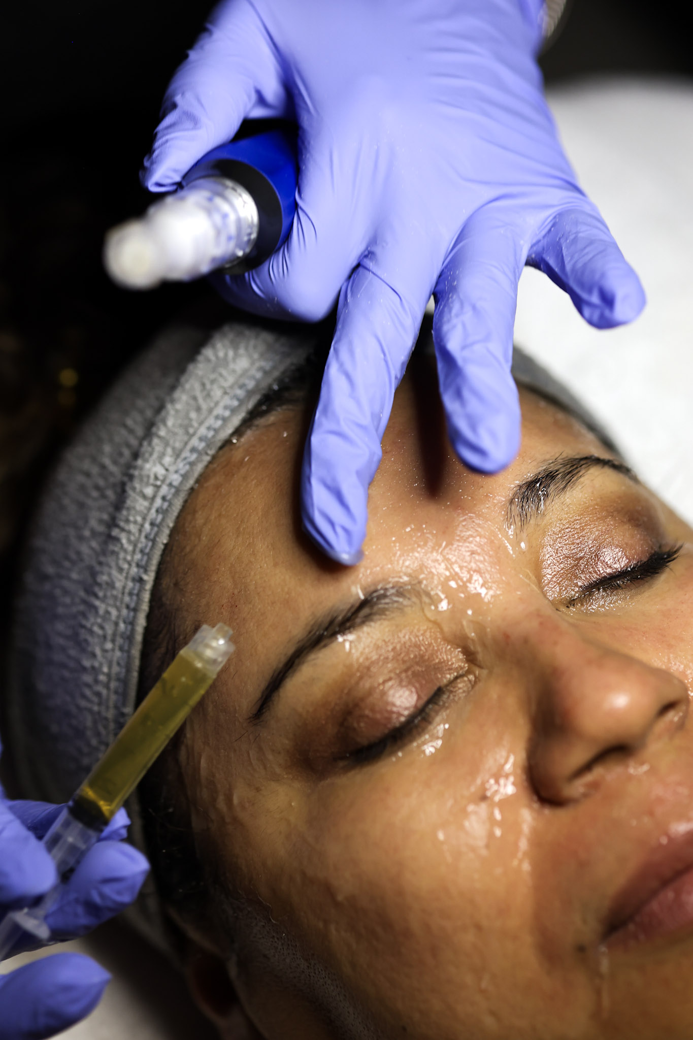 FACIAL - PRP Microneedling Face Only