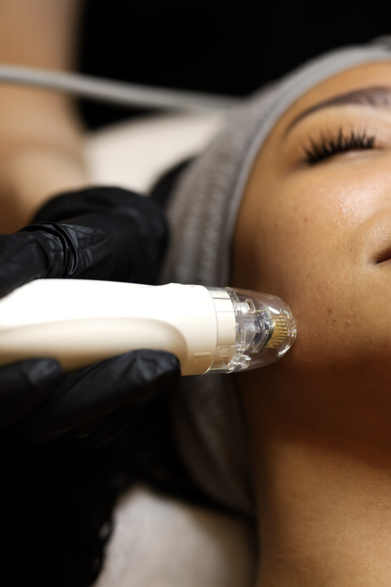 FACIAL - Vivace Ultra Face & Neck - RF Skin Tightening Microneedling