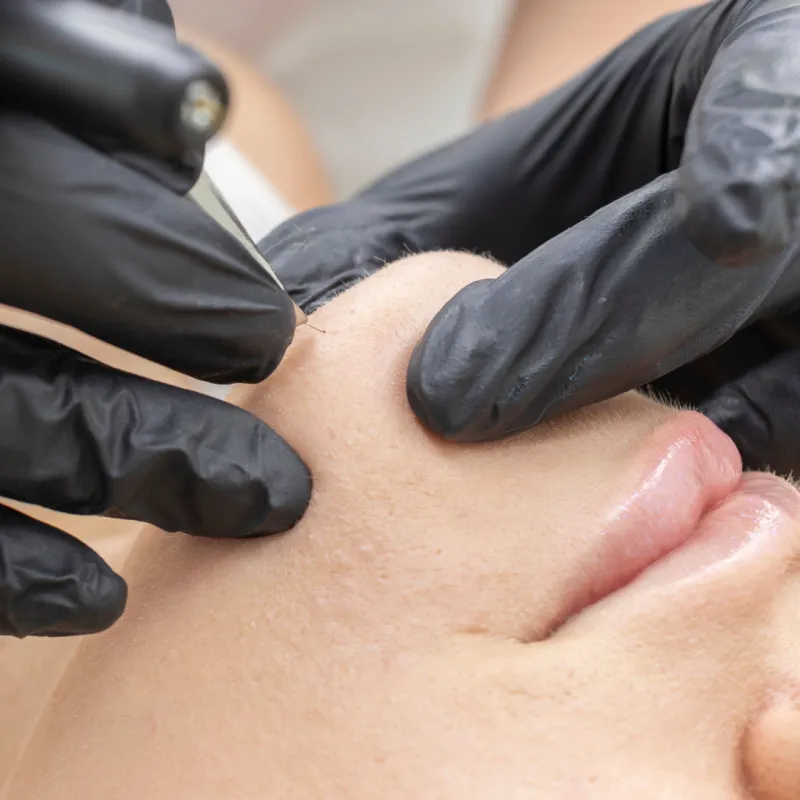 Electrolysis treatment at Knightsbridge Advanced Beauty clinic