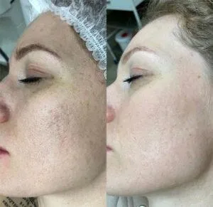 Carbon Laser Peel London Carbon Laser Treatment Hollywood Peel at Knightsbridge Advanced Beauty London