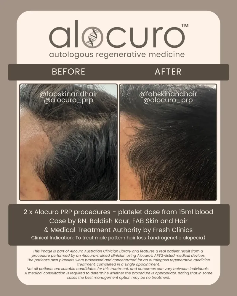 Before and after PRP hair results