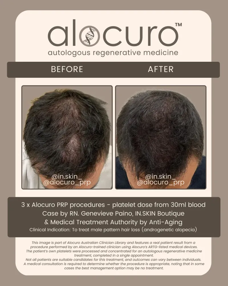 Before and after PRP hair results