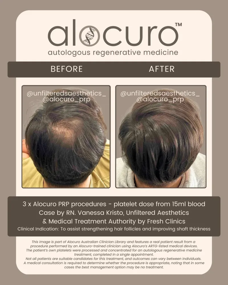 Before and after PRP hair results
