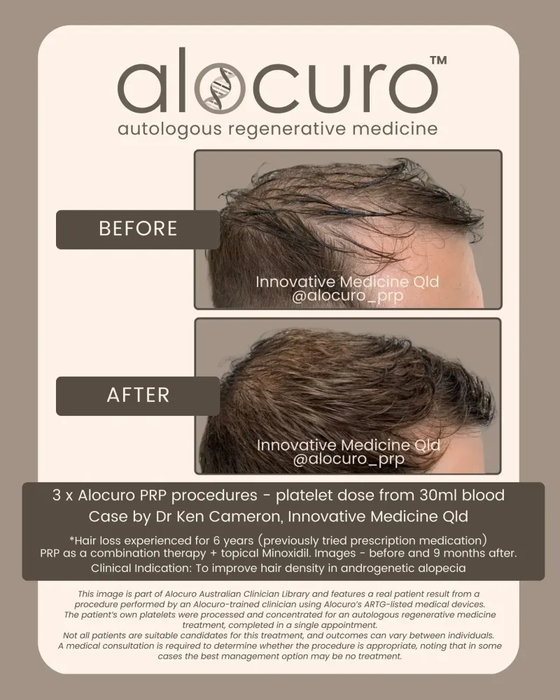 Before and after PRP hair results