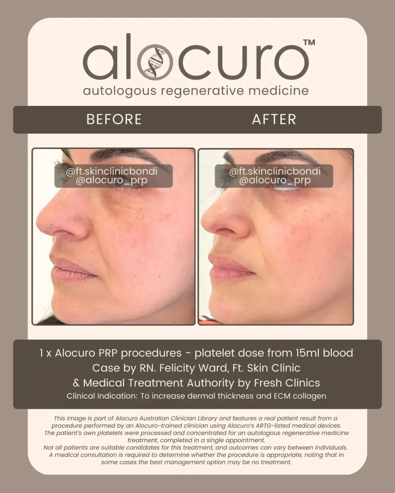 Before and after PRP skin results