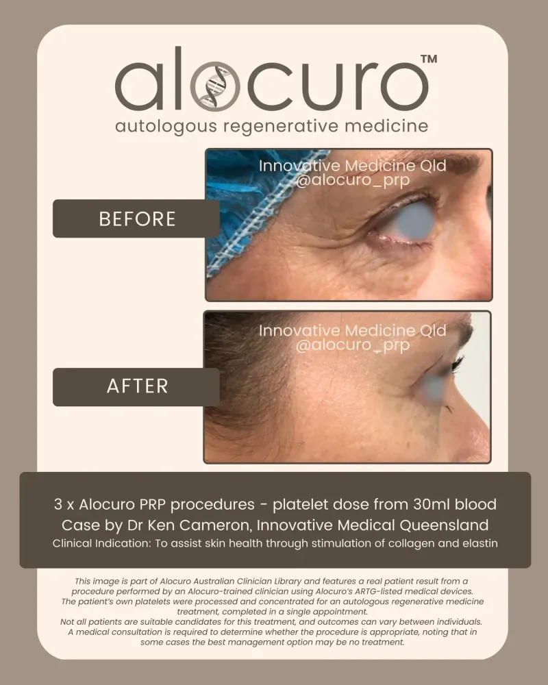 Before and after PRP skin results