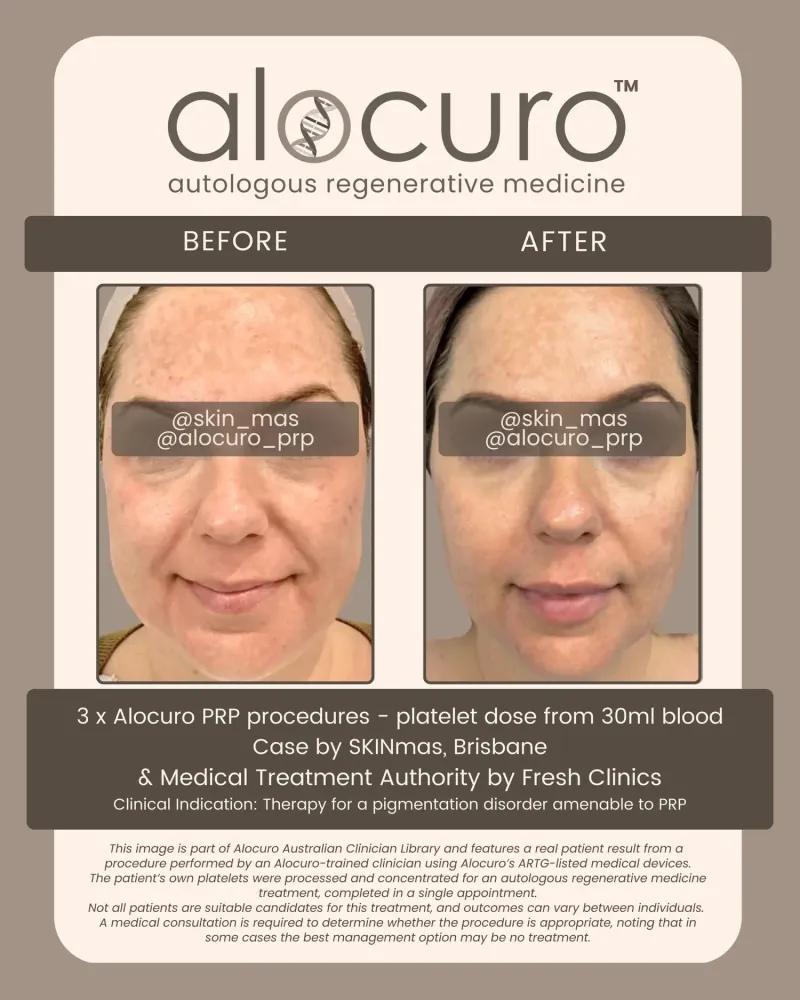Before and after PRP skin results