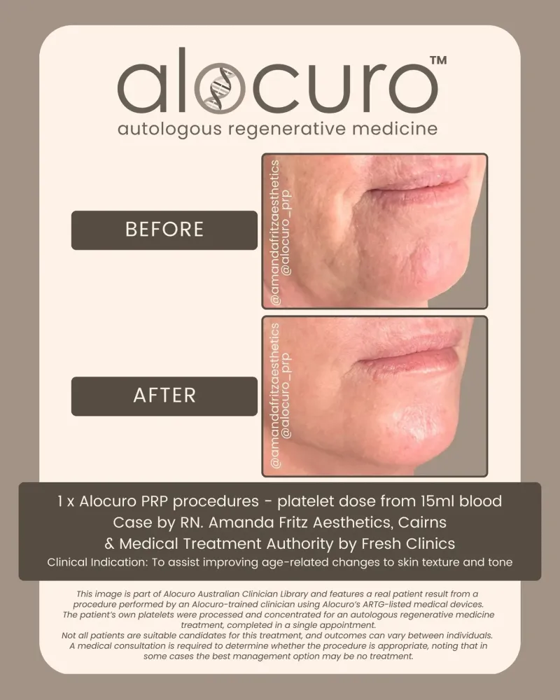 Before and after PRP skin results