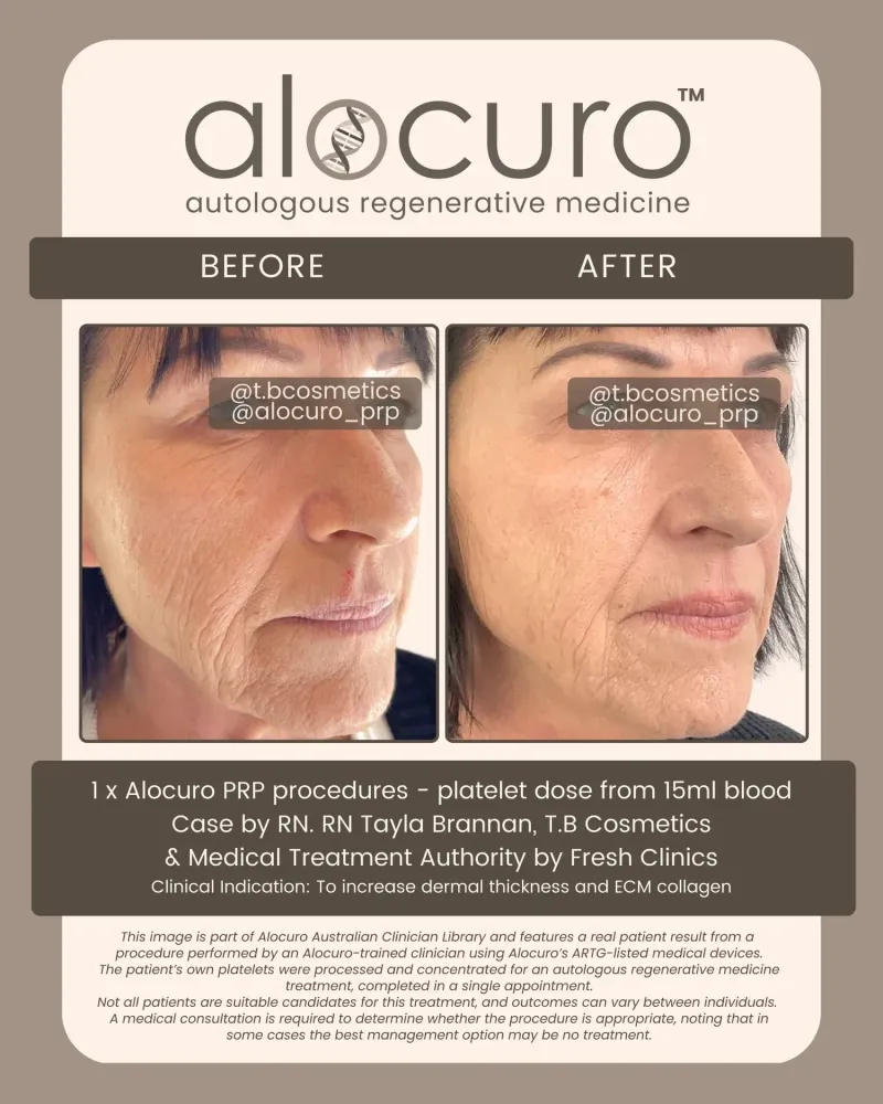 Before and after PRP skin results