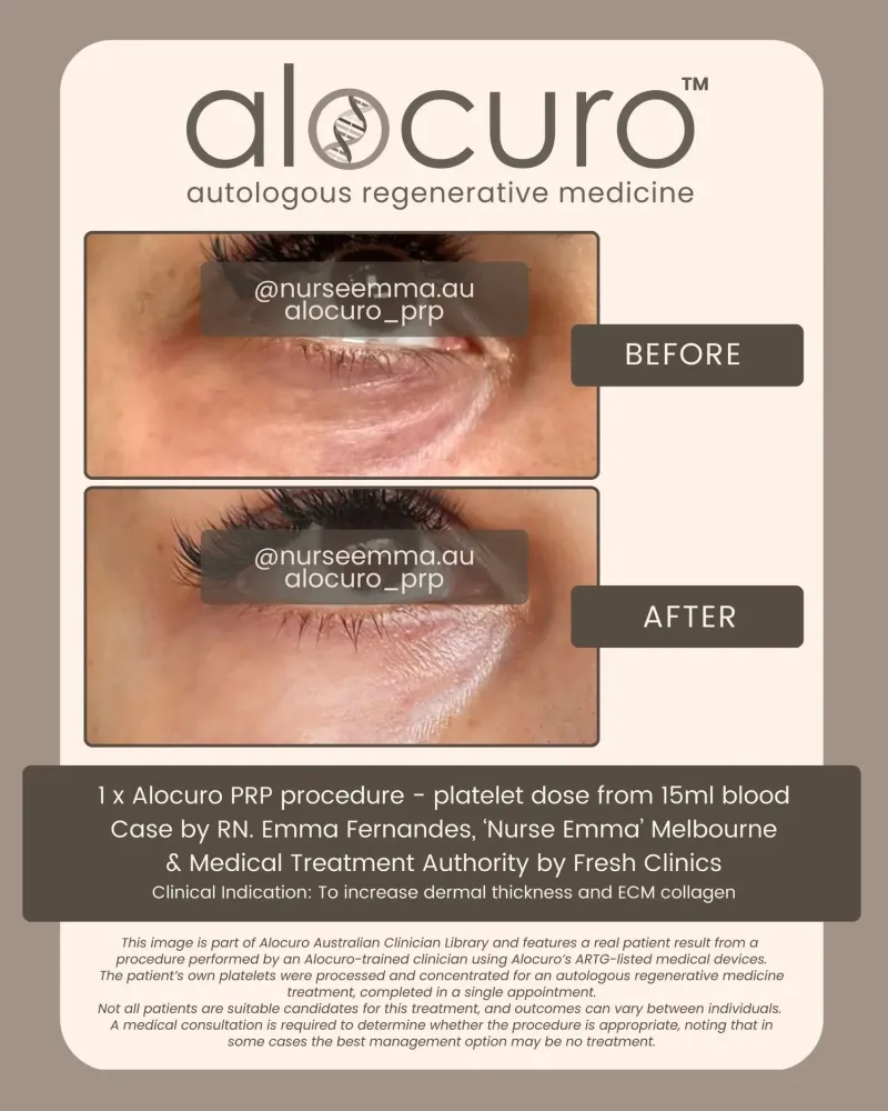 Before and after PRP skin results