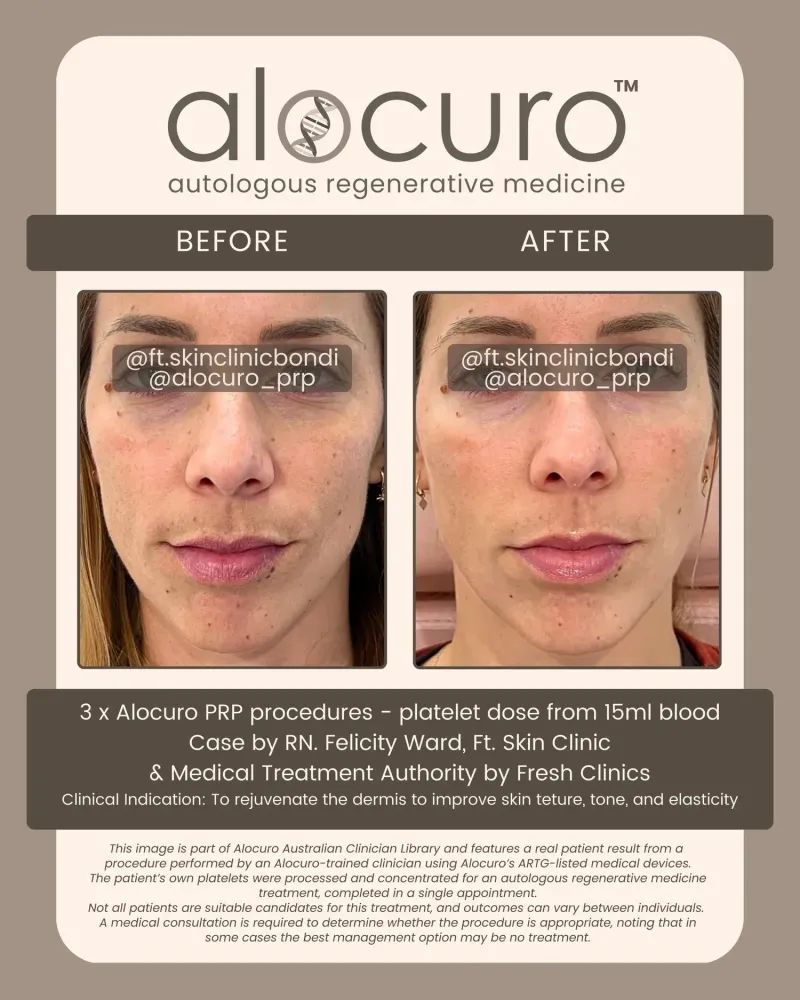 Before and after PRP skin results
