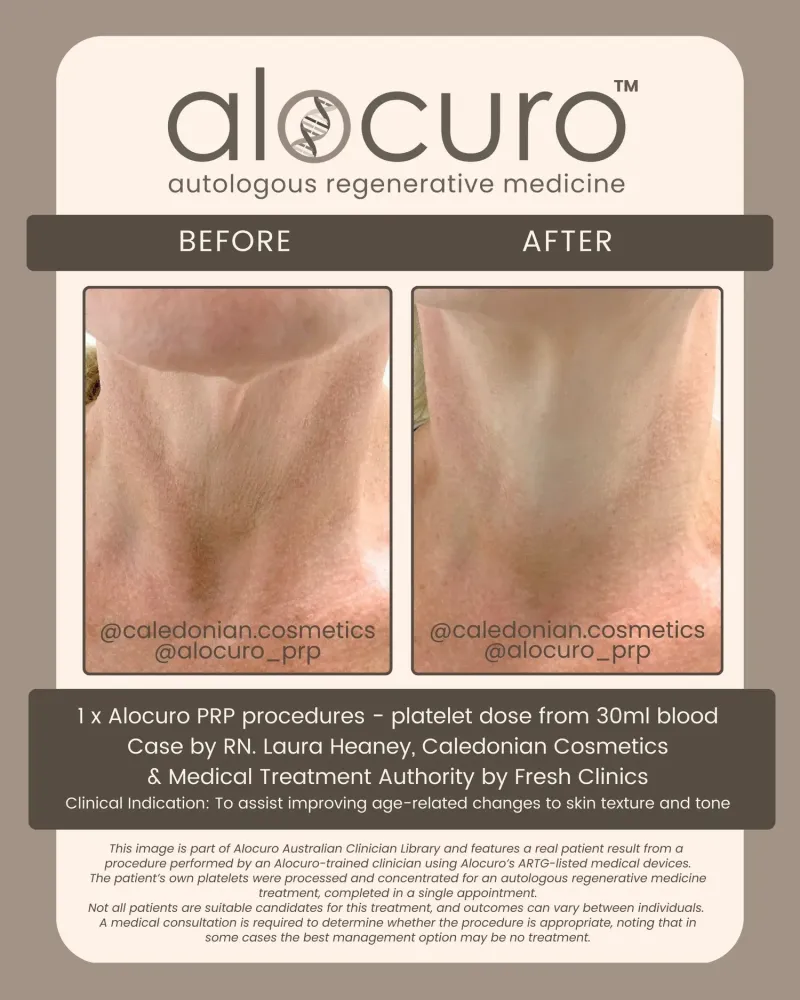 Before and after PRP skin results