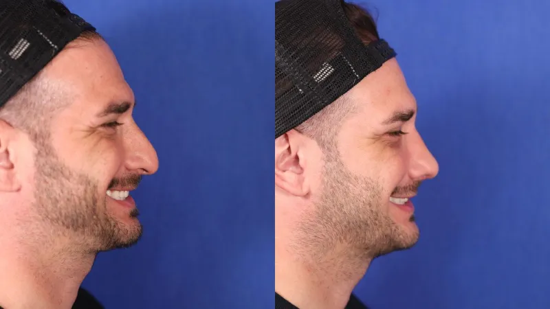 Caso 05 del Dr. Rodrigo Mina: antes a la izquierda y después a la derecha