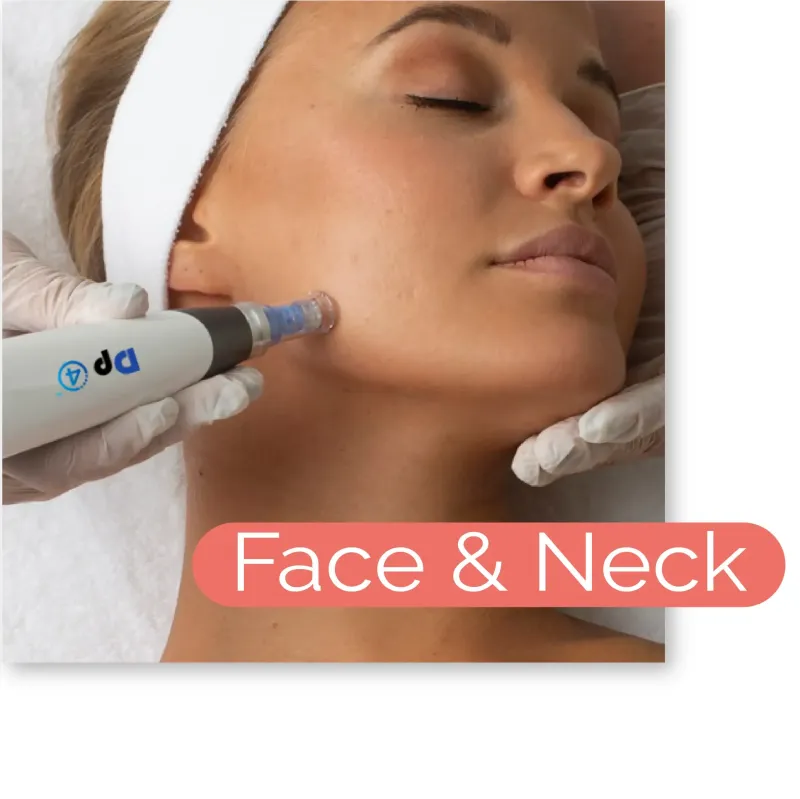 Microneedling