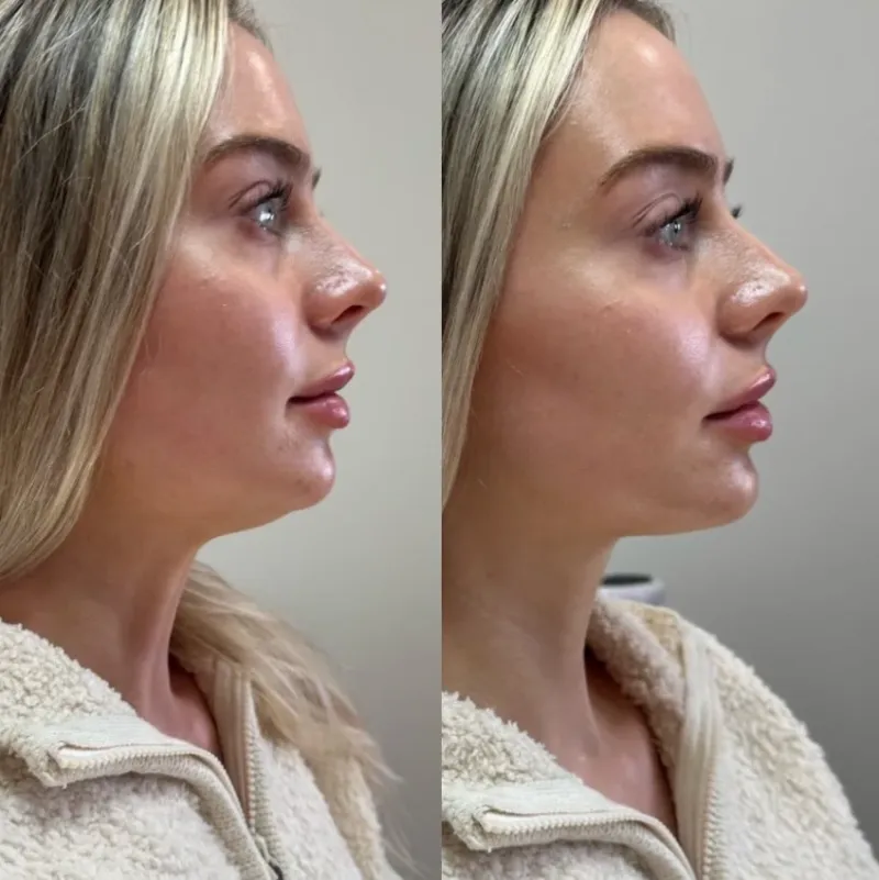 Forma Neck Tightening