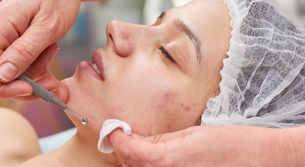 3 Acne Facial Package (LIGHT)