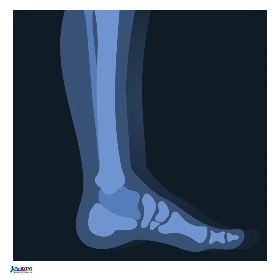 X-ray image of a lower leg and foot