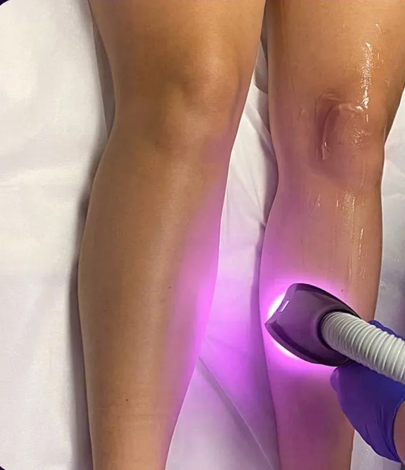 Laserbehandlung am Bein mit dem Diodenlaser bei Lasernized in Dresden