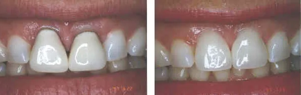 Porcelain Veneers Result