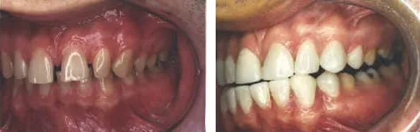 Dental Crown Result