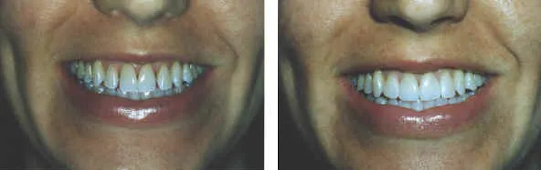 Composite Bonding Result