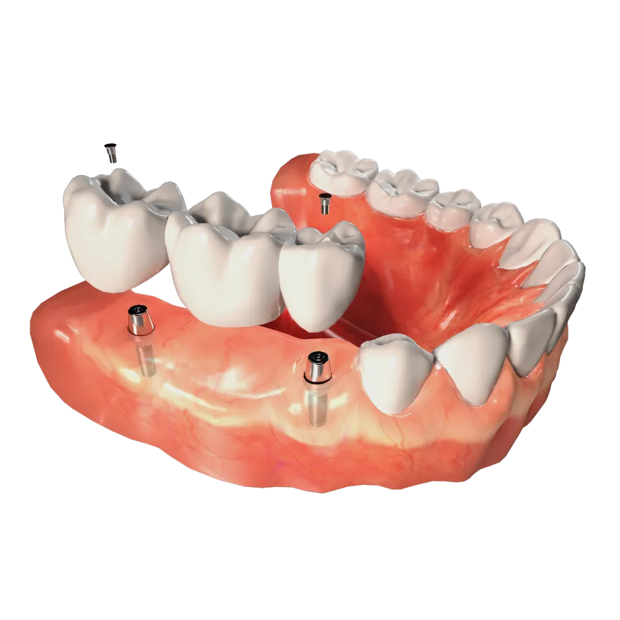 Dental Implants