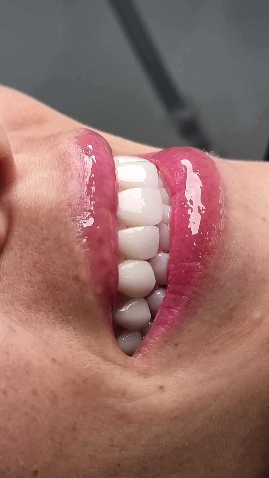 Sonrisa con carillas