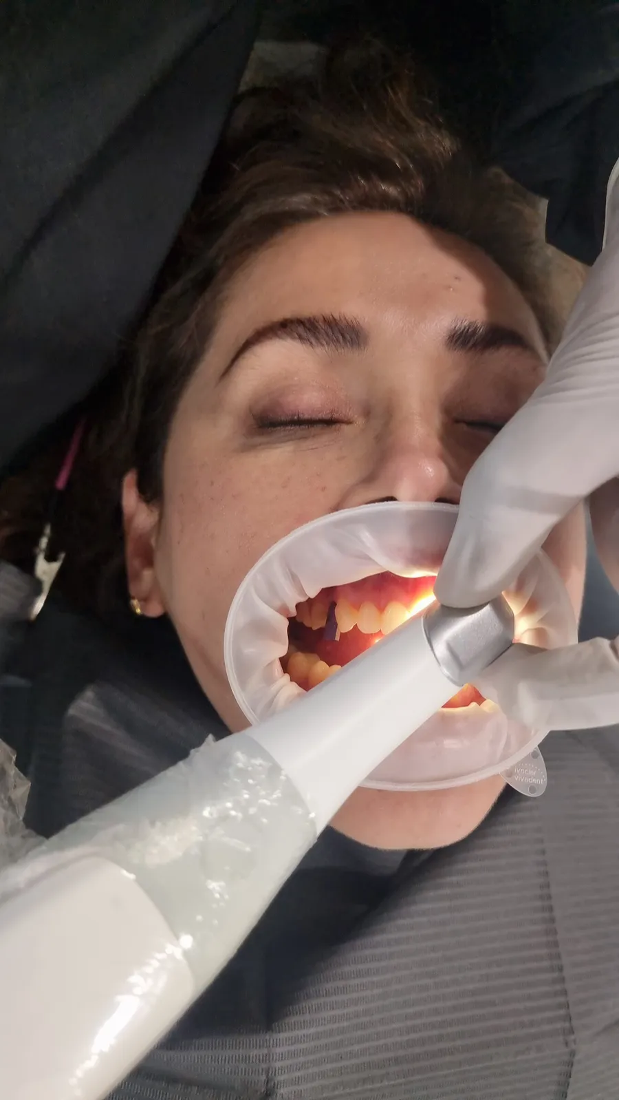 Escaneo intraoral a una paciente