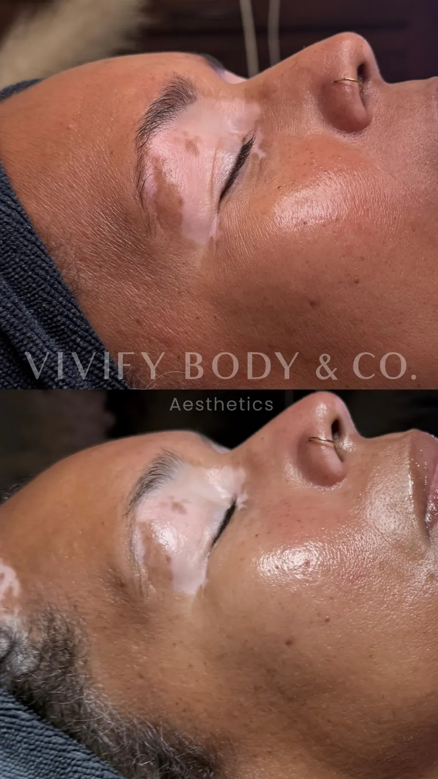 Before and after Jet Plasma on a client's eye area and cheek