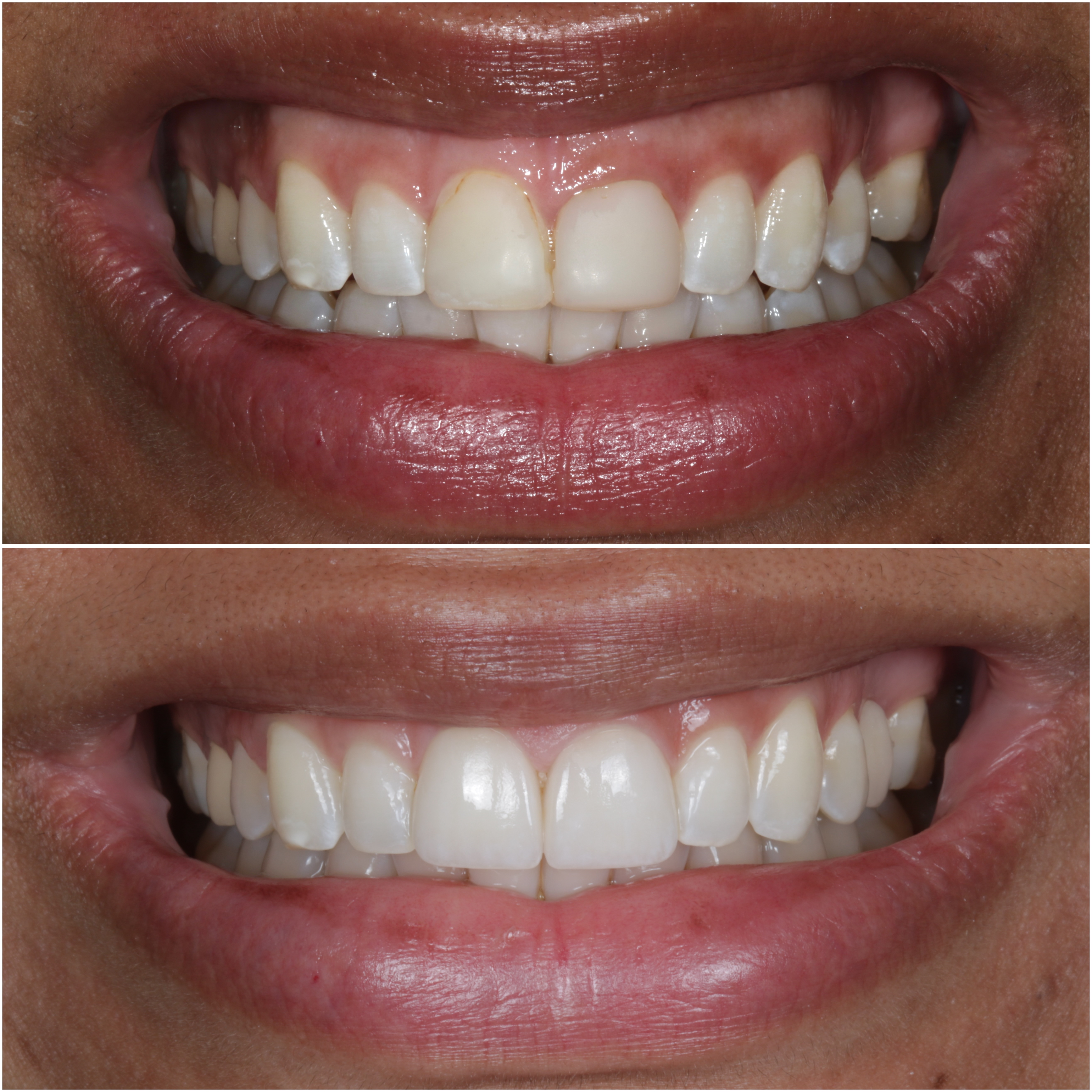 2 Porcelain Veneers Before and After
