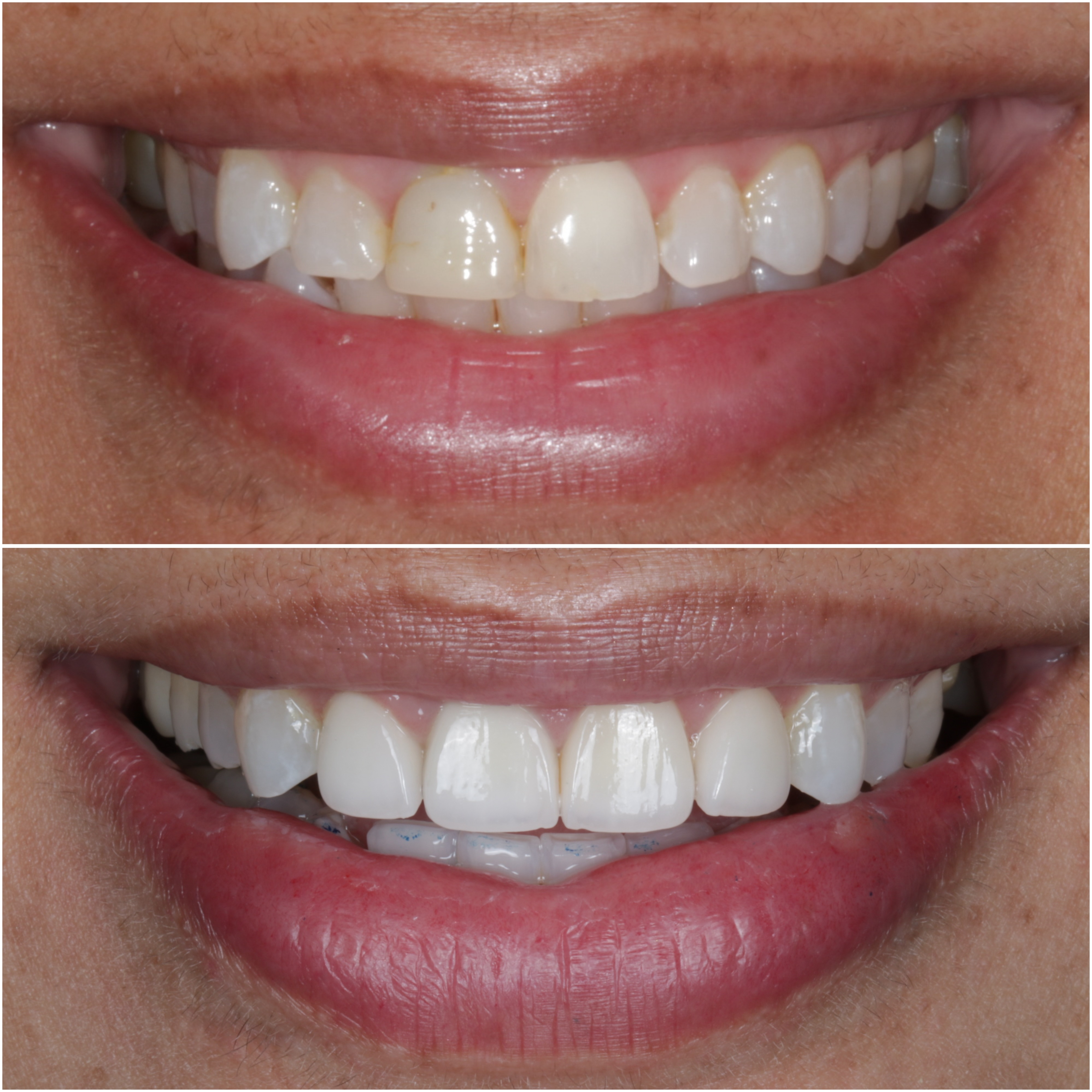 4 Porcelain Veneers Before and After