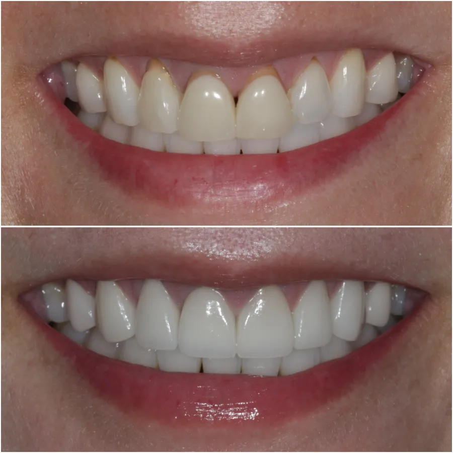8 Porcelain Veneers Before and After
