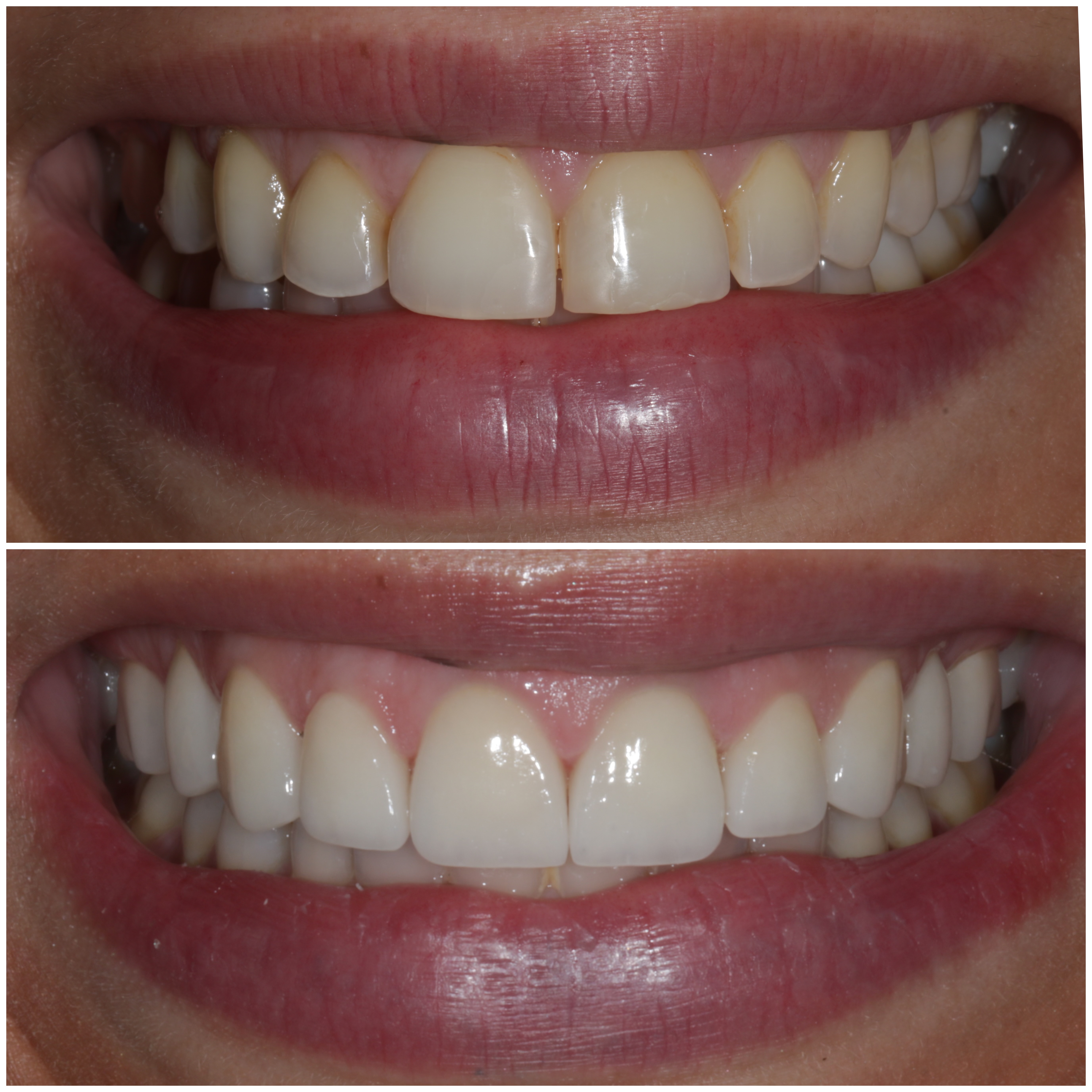 10 Porcelain Veneers Before and After