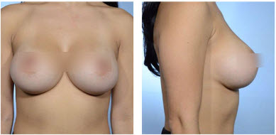 Breast Demo Photo