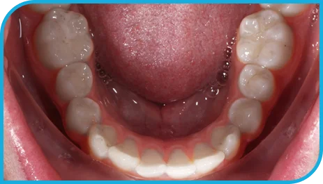 Lower Teeth Picture