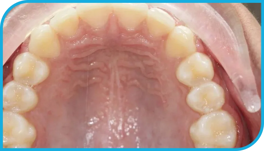 Upper Teeth Picture