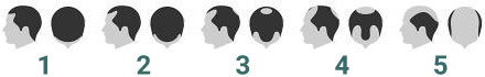 hair loss stages