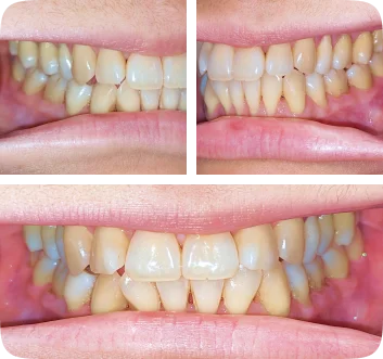 Collage of a Lai Orthodontics patient's close-ups of their smile
